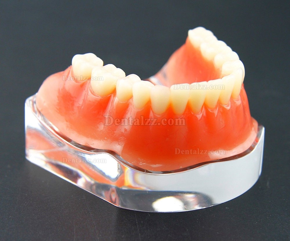 歯科用オーバーデンチャー歯モデル下顎精密インプラントモデル金色